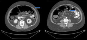Tomografía abdominal con contraste intravenoso. Se observa dilatación masiva de colon ascendente y transverso (izquierda). Se observa neumatosis intestinal y burbujas de aire libre adyacente al colon (derecha).