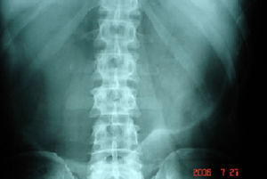 Radiografía simple de abdomen que muestra elevación importante del hemidiafragma izquierdo, con dilatación gástrica.