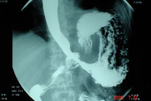 Serie gastrointestinal mostrando estómago invertido intratorácico y torsión gástrica organoaxial.