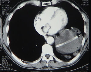 Tomografía toracoabdominal, con ascenso gástrico dentro de cavidad torácica, no identificándose el diafragma.
