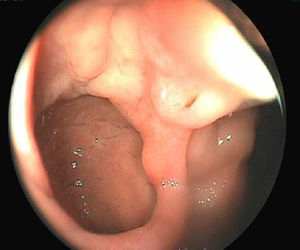 Colonoscopia que presenta imagen diverticular de 3cm de diámetro, con biopsia de mucosa gástrica heterotópica.