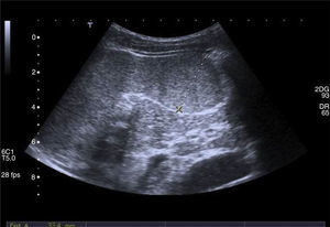 Ecografía abdominal que muestra esplenomegalia de 11 cm con lesión focal en su margen inferior de carácter inespecífico, de 3.6×3.5 cm, poco vascularizada.