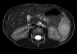 RM abdominal: se aprecian 3 lesiones focales esplénicas, una de 1.2 cm en cara medial del tercio superior, otra de 2.6 cm en la porción anteroinferior y otra de 3.3 cm en el polo inferior, protruyendo la superficie esplénica. Son levemente hipointensas en T1, con algún septo en su interior. Resto sin alteraciones.