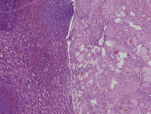 Corte histológico de la transición entre el parénquima esplénico (izquierda) comprimido por la tumoración multiquística, bien delimitada y no encapsulada con contenido proteináceo (derecha) (hematoxilina-eosina, ×2).