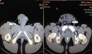 Tomografía computada abdominopélvica con aumento de volumen heterogéneo −114 a 42 UH. Flecha en el lado izquierdo: origen de la tumoración del cordón espermático. Flecha en el lado derecho: gran dimensión del tumor en la región suprapúbica.