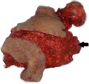 Pieza quirúrgica: resección en bloque que incluye piel con tejido celular subcutáneo. Señalado con flecha el cordón espermático de donde proviene el hemangiolinfangioma.