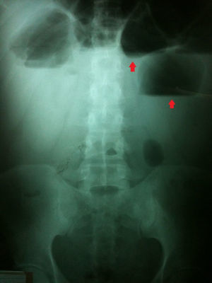 Radiografía simple de abdomen que muestra niveles hidroaéreos.