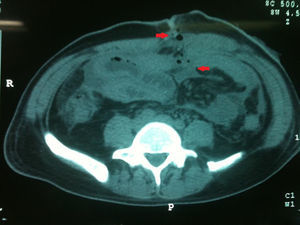 Tomografía simple de abdomen en la cual se observa el proceso inflamatorio que involucra colon ascendente, íleon distal y pared abdominal.