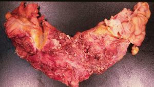 Pieza quirúrgica macroscópica, segmento de íleon y colon ascendente.