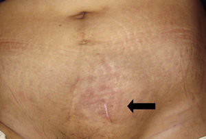 Imagen clínica de la paciente que muestra aumento de volumen en lado izquierdo suprapúbico.