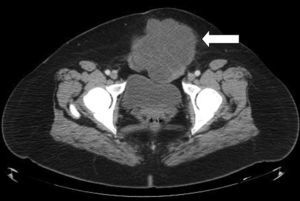 Imagen de tomografía axial computada que muestra un tumor de pared abdominal transmural que comprime la vejiga.