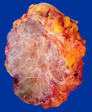 Espécimen de resección amplia de pared abdominal donde se observa una lesión nodular multiquística, de bordes delimitados con infiltración focal a tejidos blandos.