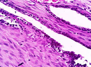 Foco de endometriosis con atipia focal, donde se observan áreas con núcleos hipercromáticos, pleomorfismo moderado y estratificación con área de transición entre células epiteliales endometriales displásicas y carcinoma de células claras (hematoxilina y eosina).