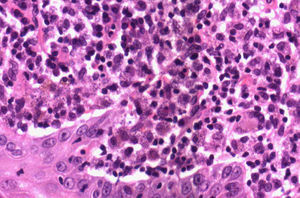 Tinción hematoxilina-eosina×60 (zonas violáceas intra y extracelulares: Leishmania).