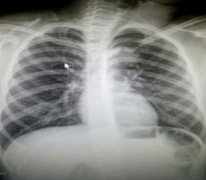 Radiografía de cuello. No se visualiza lesión en el cuello ni en el mediastino o el parénquima.