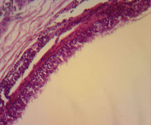 Microfotografía de la pared del quiste, que destaca el epitelio ciliado de la pared interna del quiste.