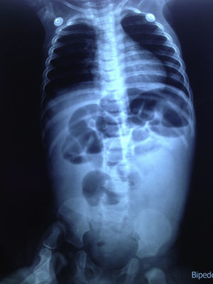 Radiografía de abdomen en bipedestación que muestra distribución irregular de aire, niveles hidroaéreos y datos francos de obstrucción intestinal mecánica.