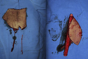 Colgajo libre de la arteria epigástrica inferior profunda (izquierda) y colgajo libre de peroné con isla cutánea (derecha). Se utilizó injerto de vena safena anastomosado proximalmente en forma termino-lateral a arteria femoral superficial y distalmente, a la parte proximal de la arteria epigástrica inferior profunda del colgajo arteria epigástrica inferior profunda. La boca distal de esta última se unió a la arteria peronea del colgajo de peroné (colgajo secuencial).