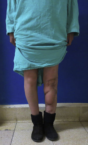 Resultado a 3 años del postoperatorio.