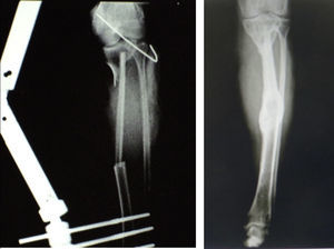 Radiografía a las 2 semanas (izquierda) y a los 3 años (derecha) de postoperada. A los 3 años de la cirugía inicial se observa integración completa e hipertrofia marcada del colgajo de peroné en el lecho receptor igualando casi en su totalidad el diámetro de la tibia.
