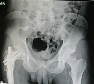 Masculino de 36 años, con falta de consolidación en fémur por fractura en sitio de una resección, 15 años antes, de un sarcoma de Ewing. Fractura en sitio patológico con rotura de clavo centromedular.