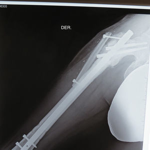 Se realizó recambio de clavo centromedular y colgajo libre microvascular de peroné a manera de «entablillado» anastomosado a vasos epigástricos inferiores superficiales con injerto de safena para la vena y la arteria. Resultado a 6 meses de postoperado.
