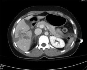 Ejemplo de tomografía computada con contraste intravenoso en un paciente con trauma contuso abdominal a su ingreso en Urgencias y en la cual se puede apreciar una lesión hepática grado III de la AAST-OIS.