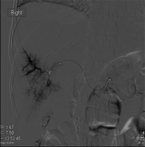 Ejemplo de angiografía más angioembolización selectiva para el manejo de hemorragia en una lesión hepática grado IV de la AAST-OIS secundaria a trauma contuso. El paciente no necesitó ser llevado a laparotomía exploradora ya que el procedimiento por radiología intervencionista fue exitoso.
