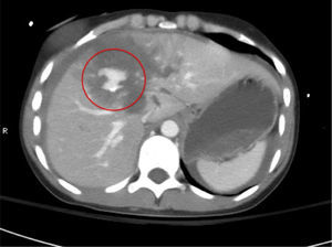 Tomografía computada con contraste intravenoso que ejemplifica una lesión grado IV de la AAST-OIS con presencia de extravasación activa de material de contraste (blush) señalado con el círculo en color rojo.