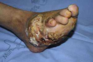Extensa úlcera en cara lateral del pie derecho (zona de salida del rayo) con bordes elevados y pétrea al tacto.
