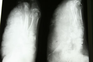 Radiología del pie: ausencia completa del 4° y 5° radios, con destrucción parcial del cuboides, la 3ª cuña y fractura de la falange proximal del 3er dedo. Marcado aumento de la densidad del tejido de partes blandas adyacentes a la afectación ósea.