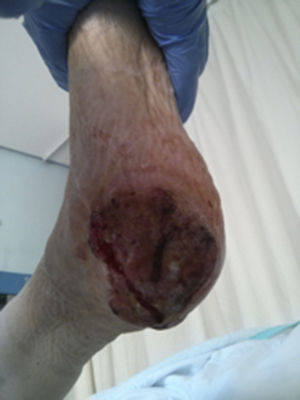 Úlcera en talón derecho, pétrea al tacto, friable y con celulitis asociada en la planta del pie.