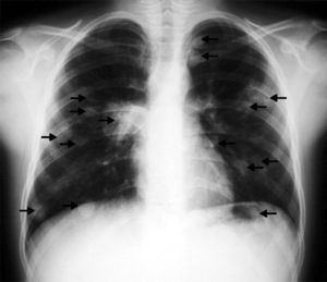 Radiografía de tórax. Se aprecian numerosos nódulos pulmonares (flechas). Infiltrado parahiliar derecho.