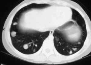 Sección torácica inferior. Se aprecian varios nódulos en las bases pulmonares.