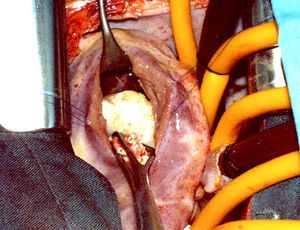 Fotografía de la cirugía con quiste hidatídico abierto en la que se ven las vesículas hijas.