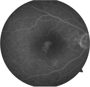 Imagen de angiografía fluoresceínica en fases tardías del ojo derecho.