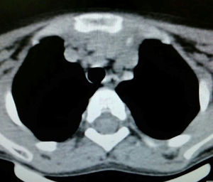 Tomografía axial. Se aprecia masa central que afecta mediastino anterosuperior y que envuelve aorta y vena cava, mínima compresión de vía aérea.