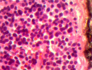 Se aprecia celularidad mixta con células poligonales redondas con núcleos vesiculosos prominentes, células linfoides de aspecto inmaduro mezclados entre sí que adoptan un patrón difuso. Cápsula íntegra sin invasión.
