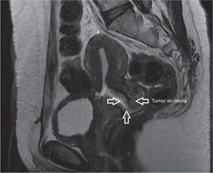 Imagen de resonancia magnética nuclear con la evidencia de tumor en cérvix uterino (flechas).