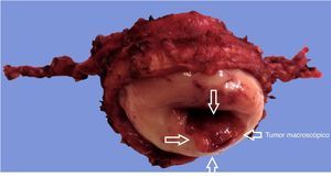 Pieza quirúrgica de la traquelectomía radical. Tumor macroscópico (flechas).