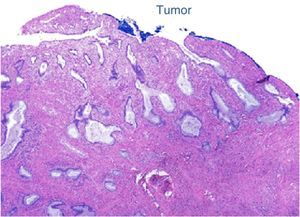 Corte histológico del tumor, hematoxilina/eosina.