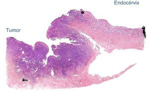 Corte histológico del tumor y su relación con el endocérvix, hematoxilina/eosina (H/E).