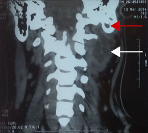 Tomografía computada de cuello contrastada en corte coronal en la cual se observa colección purulenta en espacios profundos de cuello (flecha blanca) y datos de mastoiditis ipsilateral (flecha roja).