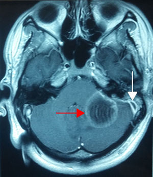 Resonancia magnética nuclear de cráneo, corte axial en secuencia T1+gadolinio; observe el absceso cerebeloso (flecha roja) y la meninge engrosada a nivel del seno sigmoides izquierdo (flecha blanca).