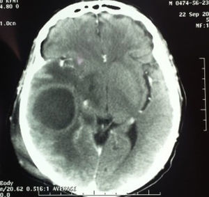 Tomografía computada de cráneo contrastada; observe absceso cerebral con edema perilesional y edema en tejidos blandos.