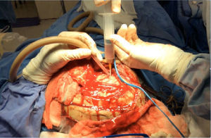Craniectomía+drenaje del absceso cerebral y capsulectomía.
