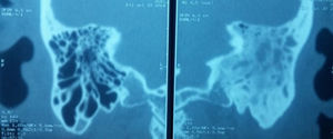 Tomografía computada de oídos, cortes coronales, en la cual se observa mastoides izquierda bien desarrollada con celdillas ocupadas por imagen isodensa a tejidos blandos, derecha sin alteraciones.