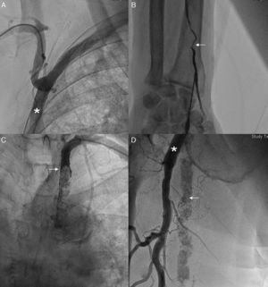 A) Evidencia de gran angulación de la subclavia derecha tras la salida del bypass axilobifemoral (asterico). B) Estenosis de la arteria radial izquierda (flecha). C) Suboclusión a nivel del tercio proximal de la subclavia izquierda (flecha). D) Gran calcificación a nivel de la arteria femoral superficial (flecha) con bypass axilofemoral (asterisco) conectado a la arteria femoral profunda.