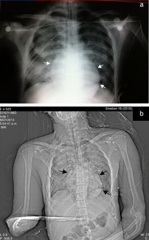 (a y b) Radiografía de tórax. Se observan amplias zonas de consolidación del parénquima pulmonar, observando adyacente al margen cardiaco una tenue línea radiolúcida que corresponde a neumopericardio.