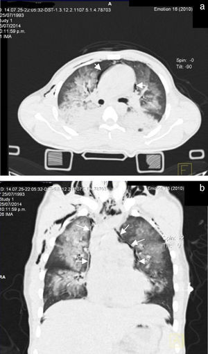 (a y b) Tomografía simple de tórax en corte axial y con reconstrucción coronal. Se identifican amplias zonas de consolidación y vidrio despulido con relación a contusiones pulmonares. A nivel cardiomediastinal, se aprecia halo radiolúcido pericárdico con relación a neumomediastino.